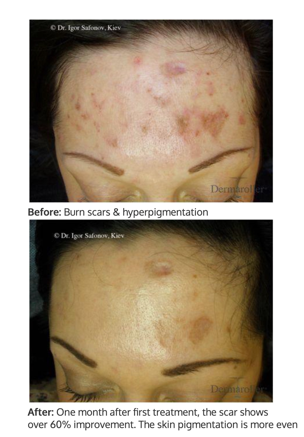 Before and After Microneedling CIT