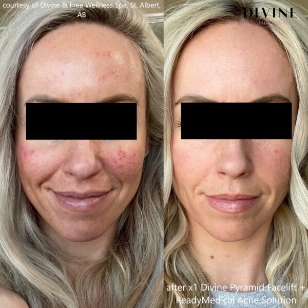 after x1 Divine Pyramid Facelift + ReadyMedical Acne Solution